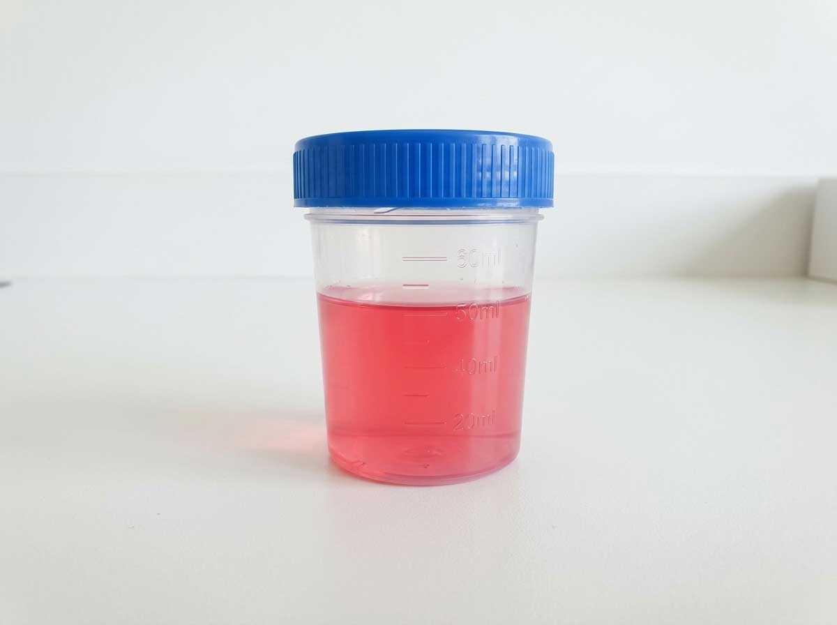 Dog urine sample showing bright red or pink blood coloration